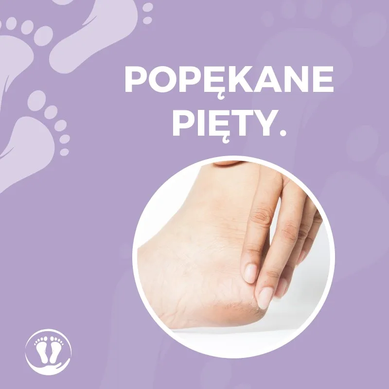 Pękające pięty