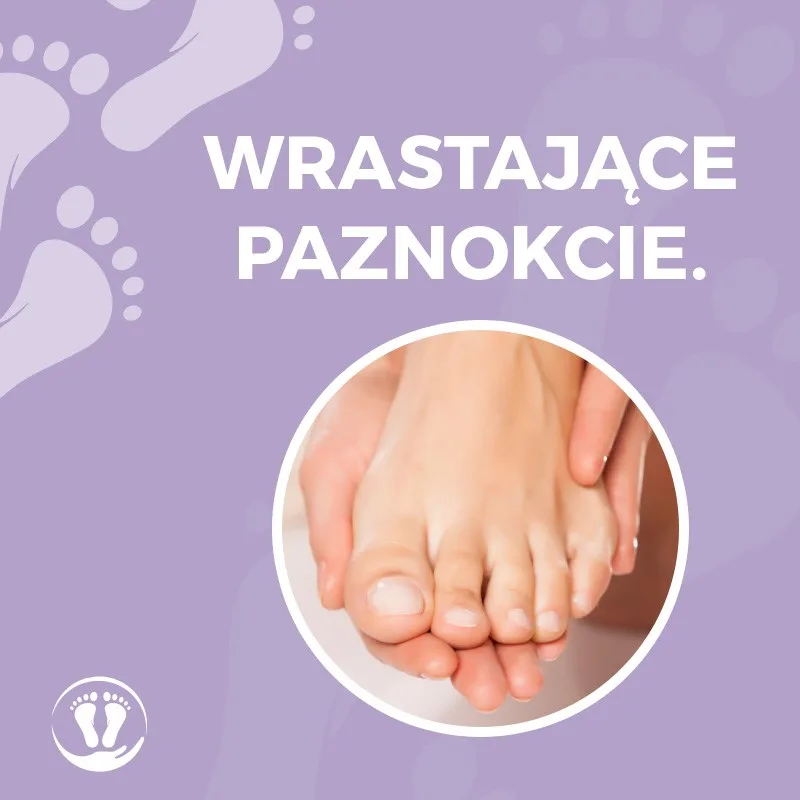 Wrastające paznokcie